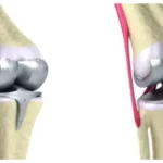 Knee Replacement Lawsuit