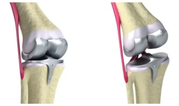 Knee Replacement Lawsuit