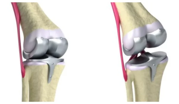 Knee Replacement Lawsuit
