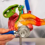 Wegovy Gallbladder Lawsuit